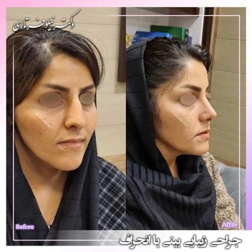 جراحی-بینی-382