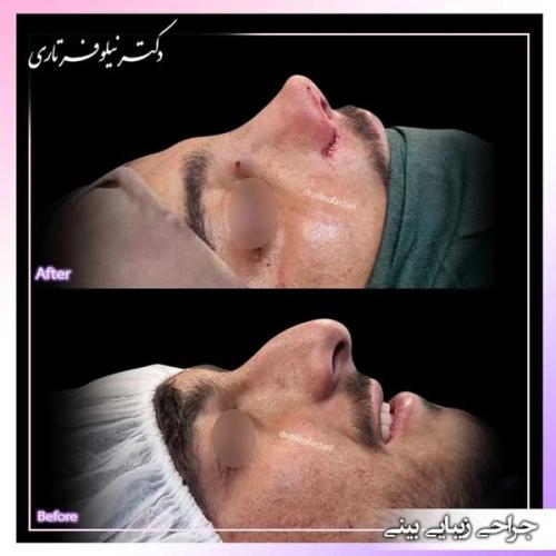 جراحی-بینی-384