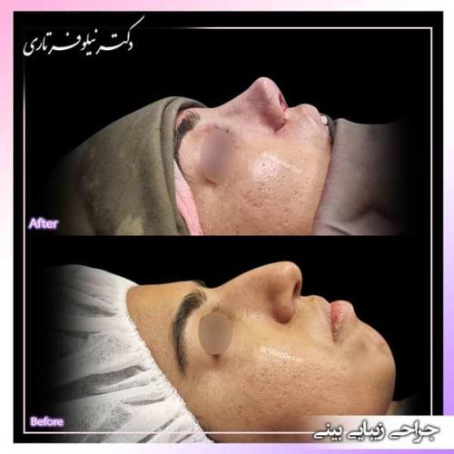 جراحی-بینی-386