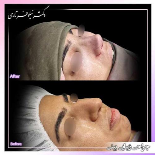 جراحی-بینی-387