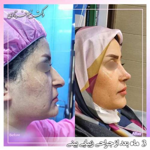 جراحی-بینی-388