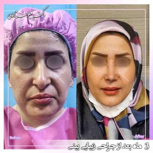 جراحی-بینی-389