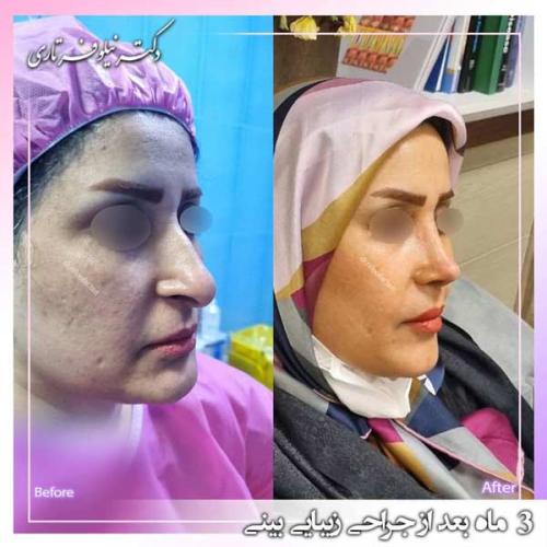 جراحی-بینی-390