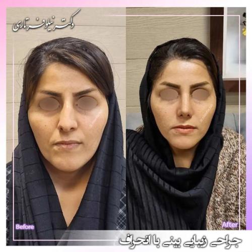جراحی-بینی-391