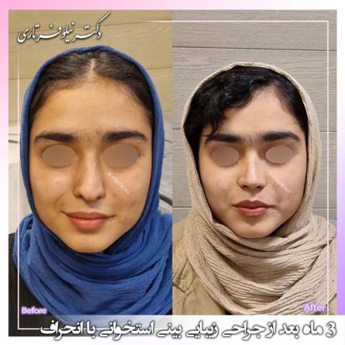 جراحی-بینی-392