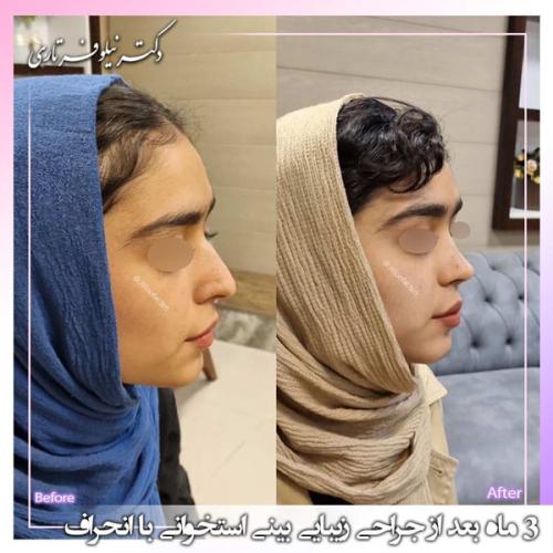 جراحی-بینی-393