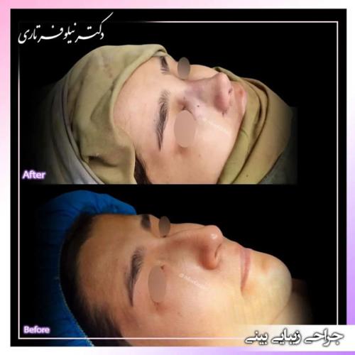 جراحی-بینی-396
