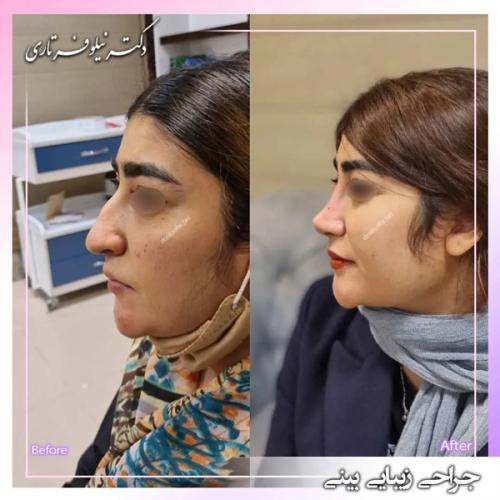 جراحی-بینی-397