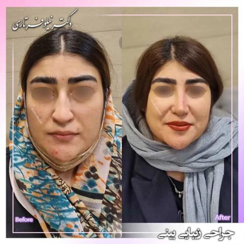 جراحی-بینی-398