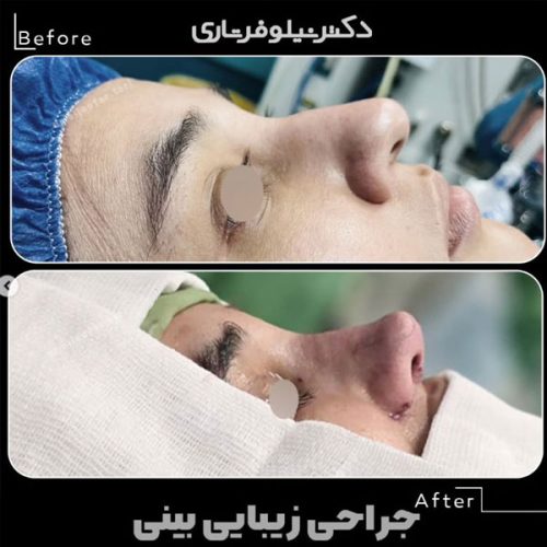 rhinoplasty-.507pg