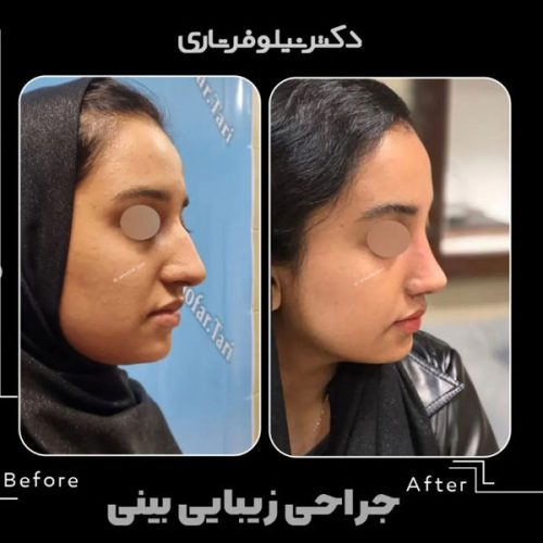 rhinoplasty-.508pg