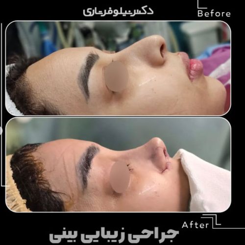 rhinoplasty-.509pg