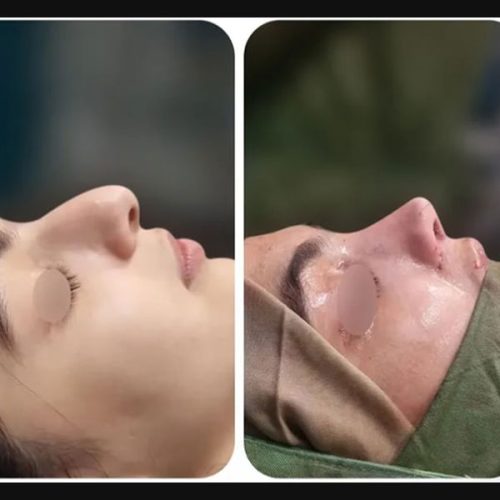 rhinoplasty-.518pg