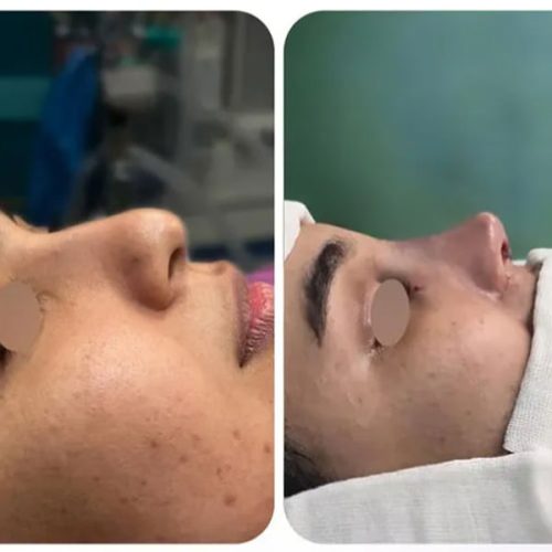 rhinoplasty-.521pg