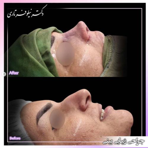 rhinoplasty-458