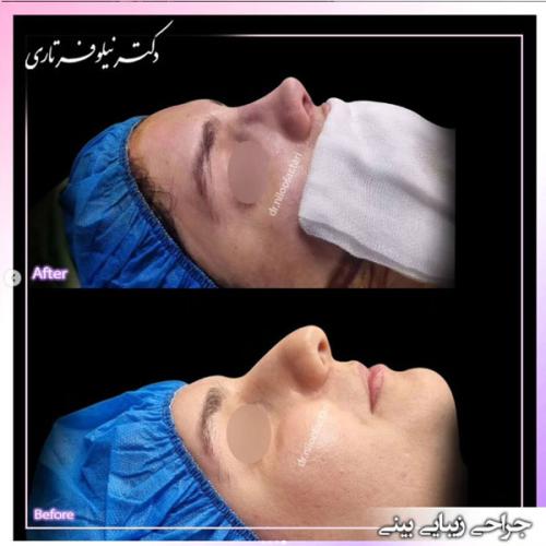 rhinoplasty-463