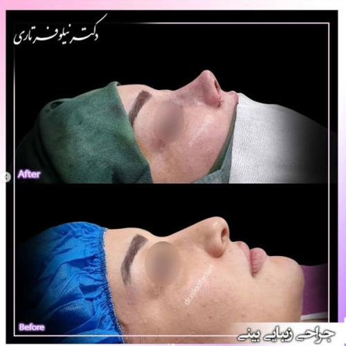rhinoplasty-470