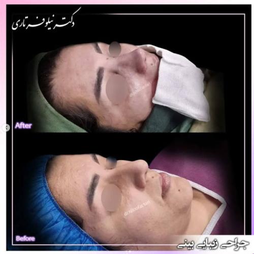 rhinoplasty-471