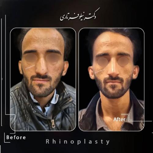 rhinoplasty-475