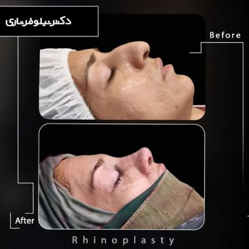 rhinoplasty-476