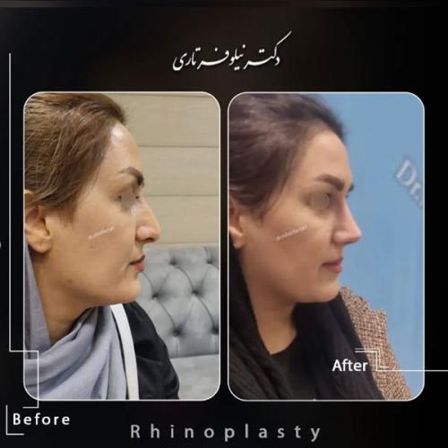 rhinoplasty-477