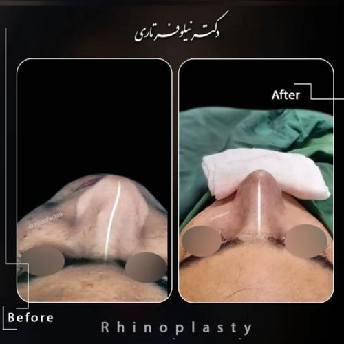 rhinoplasty-478
