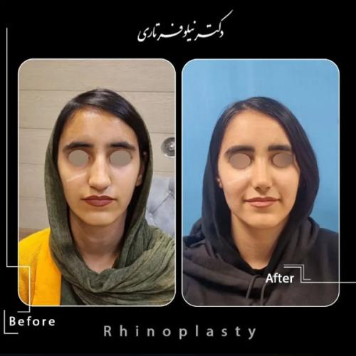 rhinoplasty-479