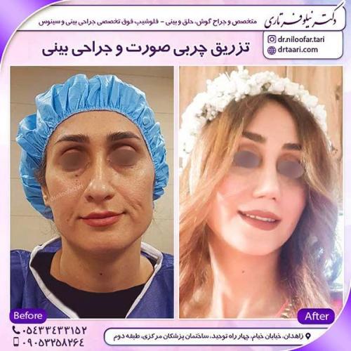 تزریق-چربی-و-جراحی-بینی-1