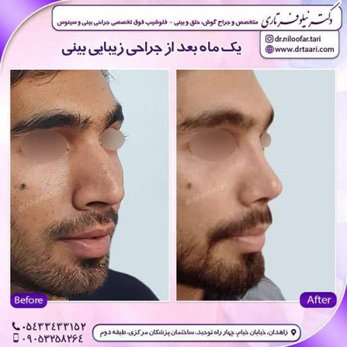 جراحی-بینی-101