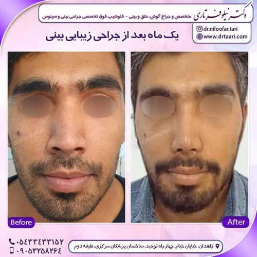 جراحی-بینی-102