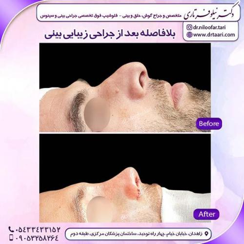 جراحی-بینی-103