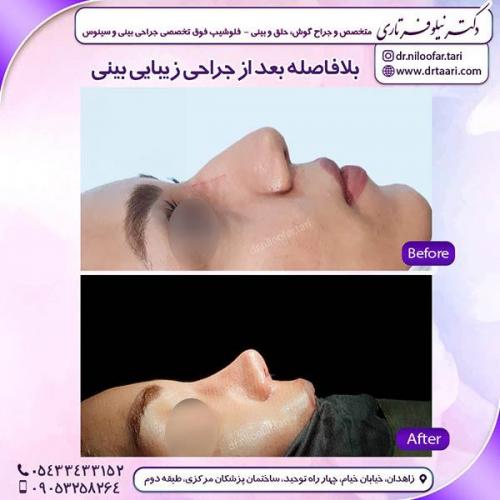 جراحی-بینی-104