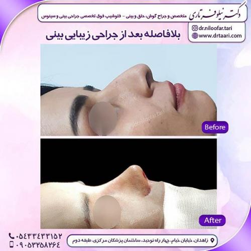 جراحی-بینی-105