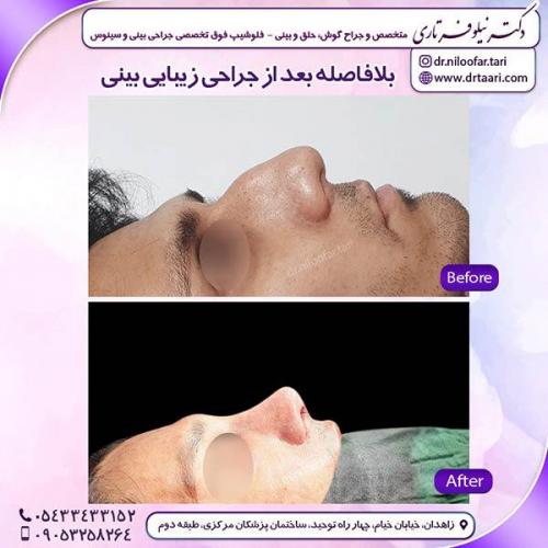 جراحی-بینی-106