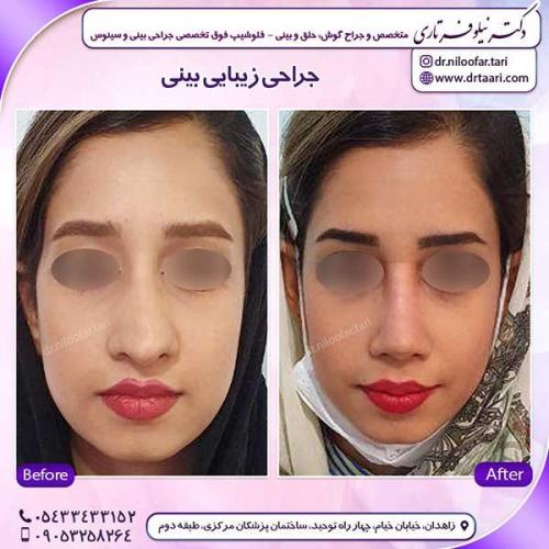 جراحی-بینی-108