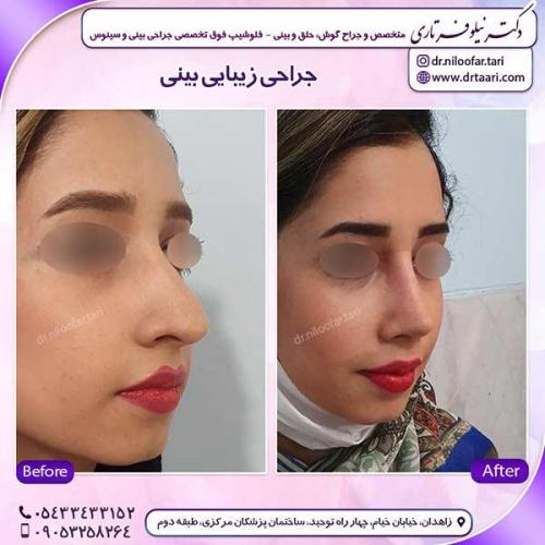 جراحی-بینی-109