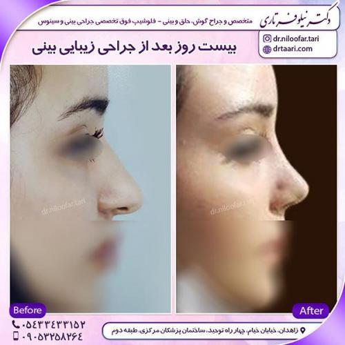 جراحی-بینی-11