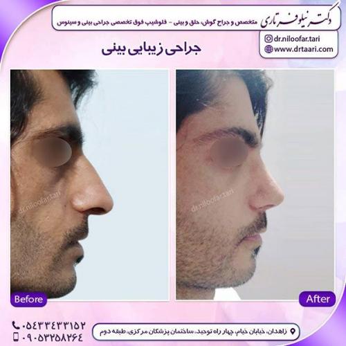 جراحی-بینی-110