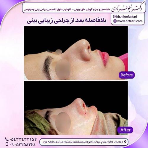 جراحی-بینی-112