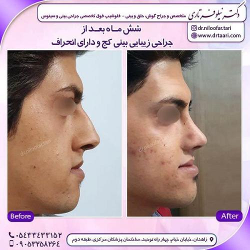جراحی-بینی-113