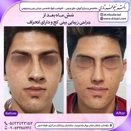 جراحی-بینی-115