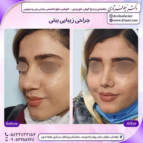 جراحی-بینی-116