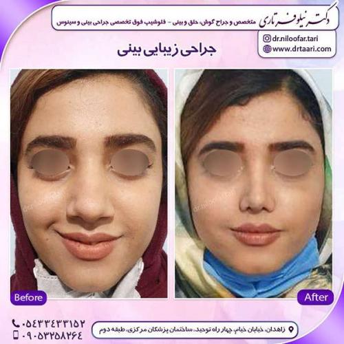 جراحی-بینی-117