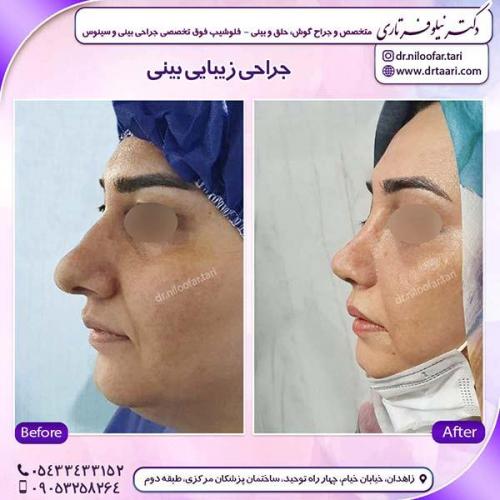 جراحی-بینی-121