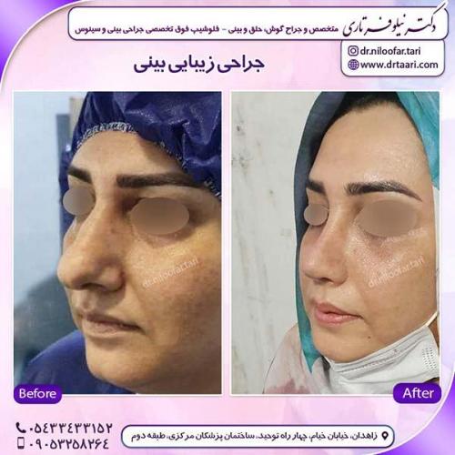 جراحی-بینی-122