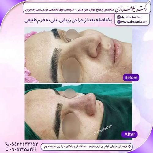 جراحی-بینی-125