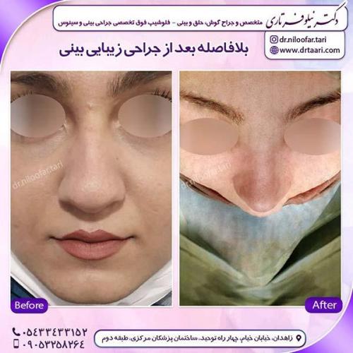 جراحی-بینی-127