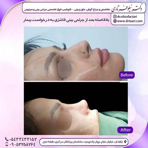 جراحی-بینی-128