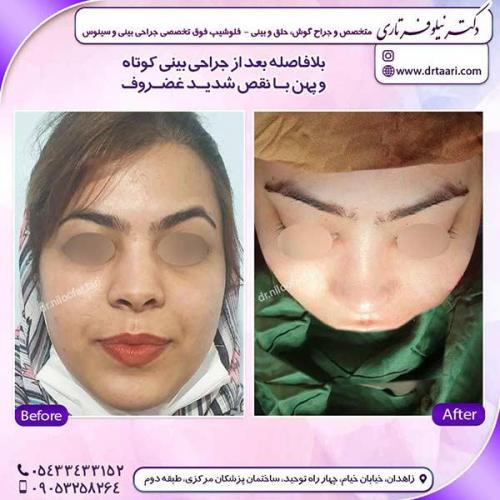 جراحی-بینی-129