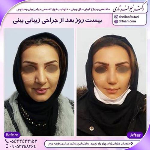 جراحی-بینی-13